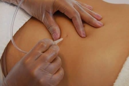 Carboxytherapy