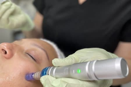 Microneedling