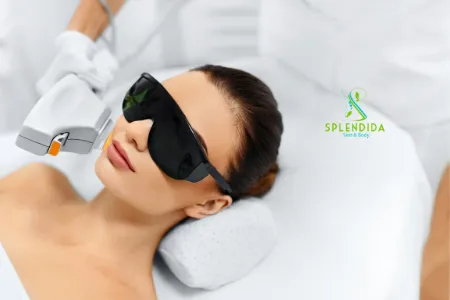 IPL Treatment