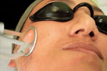 CO2 Laser Facial