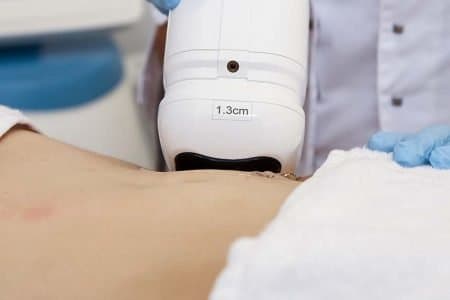 HIFU Liposonix