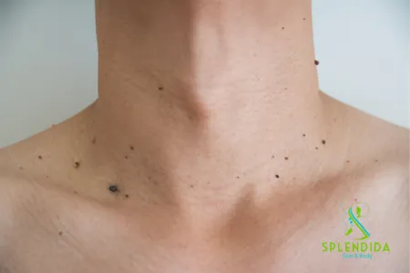 Skin Tag Removal