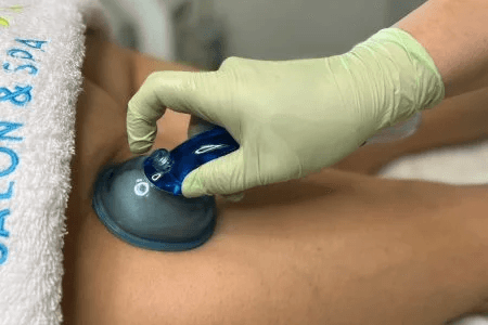 Cellulite Treatment & Toning