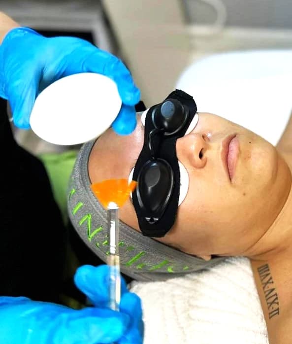 Chemical Peel
